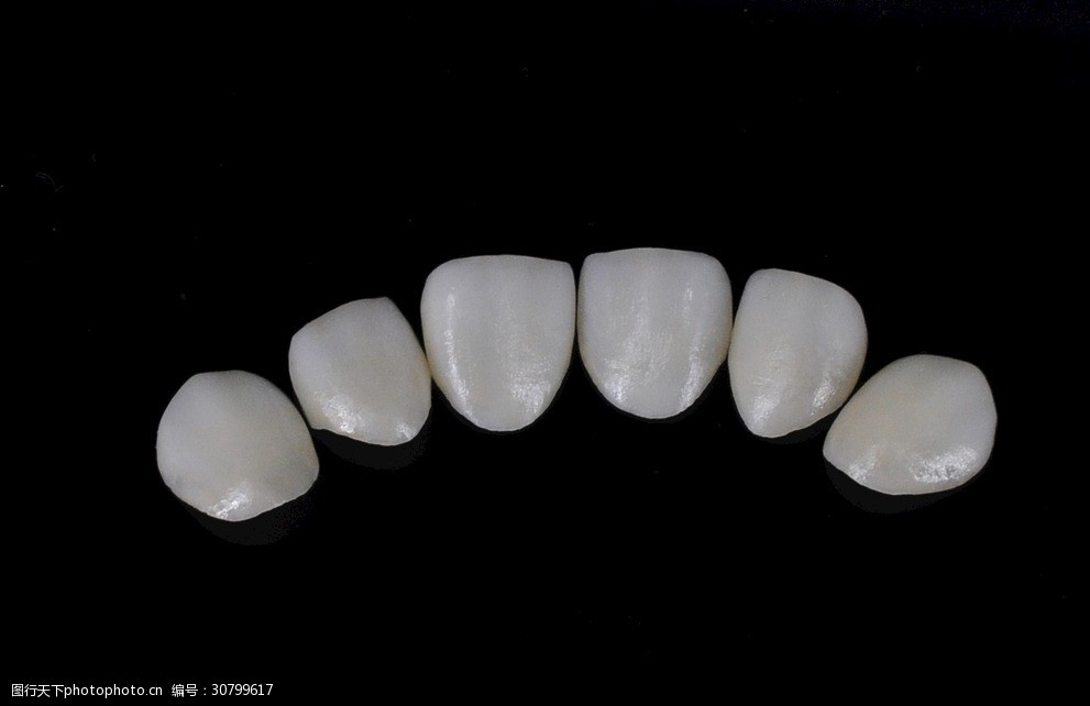 贴面义齿美学贴面超薄贴面